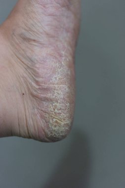 Yaya olarak kurumuş, çatlamış deriyi kapatın.