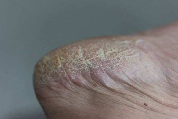 Close up of dry cracked skin on foot