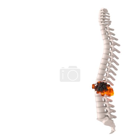 Foto de 3d representación de una columna vertebral humana que muestra el concepto de hernia discal en las vértebras lumbares - Imagen libre de derechos