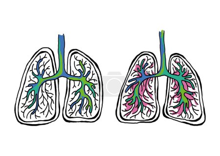 Illustration for Healthy and diseased lungs vector illustration - Royalty Free Image