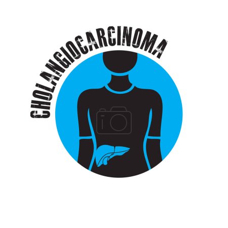 Téléchargez les illustrations : Cancer du foie et problèmes de santé - Cholangiocarcinome. Illustration vectorielle - en licence libre de droit