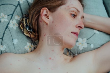 Foto de Mujer con varicela acostada en la cama retrato - Imagen libre de derechos