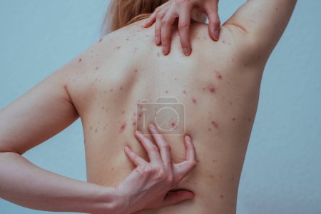 Téléchargez les photos : Une femme avec la varicelle se gratte le dos - en image libre de droit
