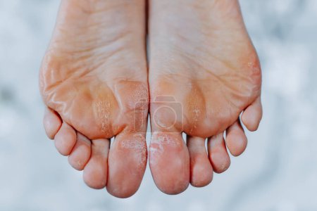 Photo for Unkempt woman feet, woman feet without pedicure - Royalty Free Image