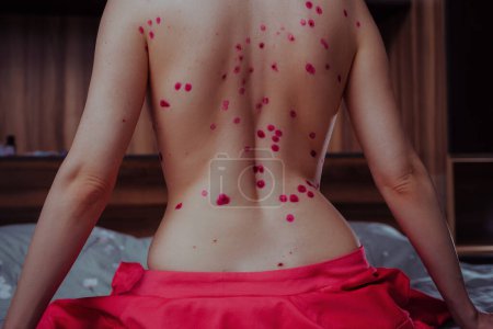 Foto de Mujer con varicela en la espalda en el dormitorio - Imagen libre de derechos