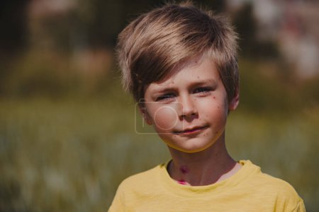 Foto de Retrato al aire libre de niño con varicela - Imagen libre de derechos