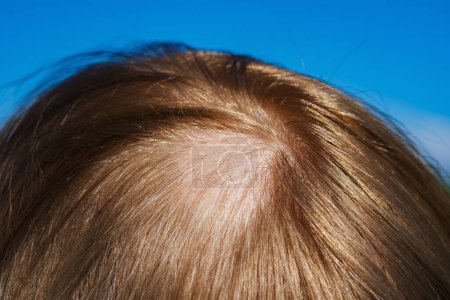 Foto de Cabeza femenina con vista de primer plano de alopecia - Imagen libre de derechos