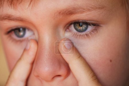 Foto de Niño alérgico rascarse los ojos vista de cerca - Imagen libre de derechos