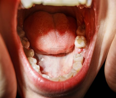 Foto de Mujer después de la extracción dental, concepto de medicina - Imagen libre de derechos