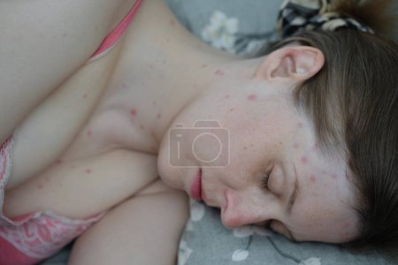 Foto de Mujer joven con varicela durmiendo en la cama - Imagen libre de derechos