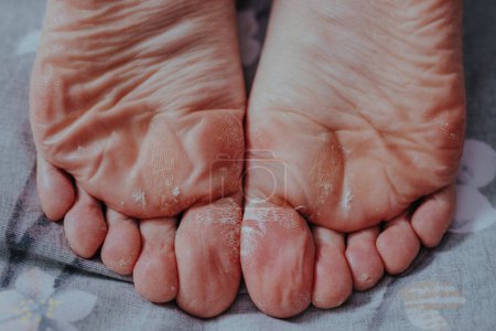 Téléchargez les photos : Peeling peau sur femme pieds vue rapprochée - en image libre de droit