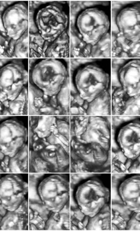 Foto de Collage de 16 imágenes médicas de ecografía 3D de anomalía en un feto femenino a los 4 meses del embarazo
. - Imagen libre de derechos