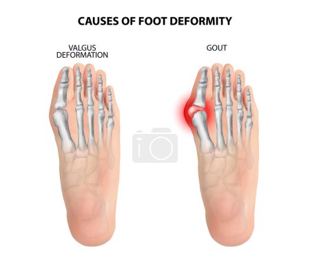 Téléchargez les illustrations : Causes of foot deformity. Vector illustration. - en licence libre de droit