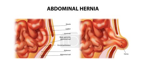 Illustration for Weak spot in the abdominal wall. Abdominal hernia. Vector illustration. - Royalty Free Image