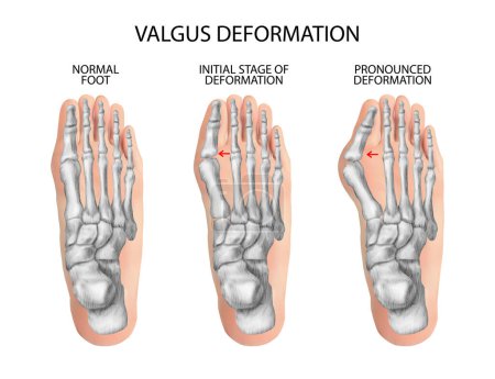Illustration for Valgus deformity of the toes. Vector illustration. - Royalty Free Image