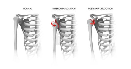 Shoulder dislocation options. Vector illustration.