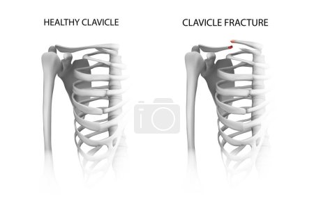 Illustration for Healthy collarbone. Clavicle fracture. Vector illustration. - Royalty Free Image