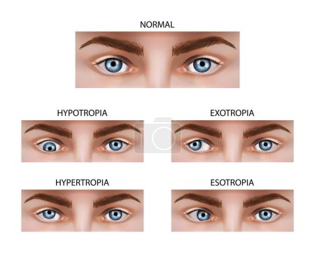 Ilustración de Different types of strabismus. Vector illustration. - Imagen libre de derechos