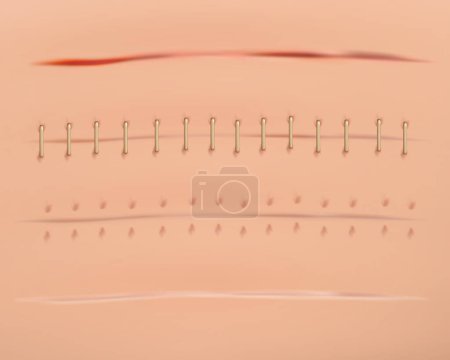 Illustration for Realistic scars. Medical surgical sutures wounds close up pictures on human skin decent vector illustrations set - Royalty Free Image
