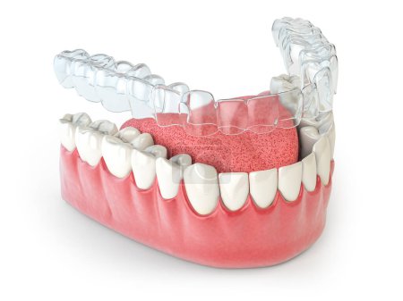 Photo for Invisalign invisible retainer  or braces with lawer jaw islated on white. 3d illustration - Royalty Free Image