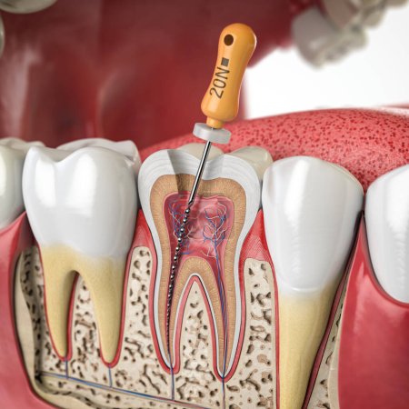 Téléchargez les photos : Coupe transversale de la dent humaine avec une lime rotative endodontique. Illustration 3d - en image libre de droit