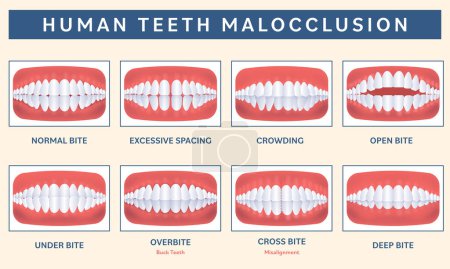 Illustration for Malocclusion of The Human Teeth Infographic Icon Set Over Peach Background. - Royalty Free Image