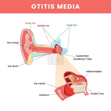 Illustration for Otitis Media Of Ear Disease Infographic Structure Colorful Background - Royalty Free Image