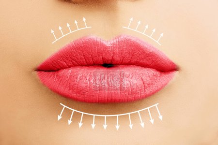 Bright female lips. Woman lips filler injectionsand lip augmentation