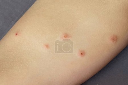 Bedbug bites. Body with skin problem. Infectious disease. Allergy, dermatitis, virus or bacterial infection. Dermatology,  medicine and health care concept. 