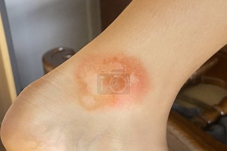 Human ankle leg closeup.  Body with skin problem. Infectious disease. Allergy, dermatitis, virus or bacterial infection. Dermatology,  medicine and health care concept. 