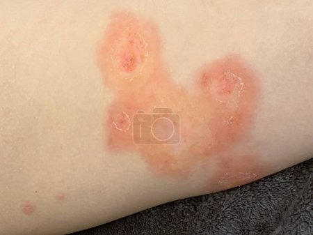 Human thigh closeup. Body with skin problem. Infectious disease. Allergy, dermatitis, virus or bacterial infection. Dermatology, medicine and health care concept. 