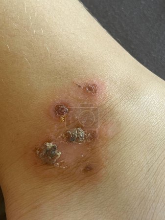 Infección bacteriana. Primer plano de la pierna humana