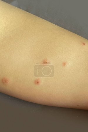 Bedbug bites on skin. Human leg close up 
