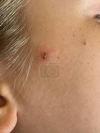 Virus or bacterial infection. Scratched pimples on human skin close up. Infectious disease 