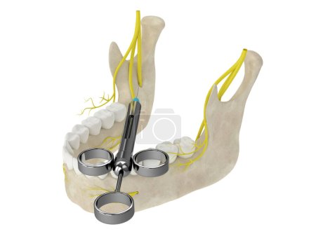 Foto de 3D renderizado de arco mandibular con bloqueo del nervio alveolar inferior. Tipos de concepto de anestesia dental. - Imagen libre de derechos
