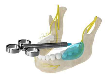 Foto de Arco mandibular con bloqueo de nervios bucales. Tipos de concepto de anestesia dental. - Imagen libre de derechos