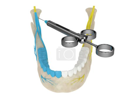 3D renderizado de arco mandibular con bloqueo nervioso de las compuertas. Tipos de concepto de anestesia dental. 