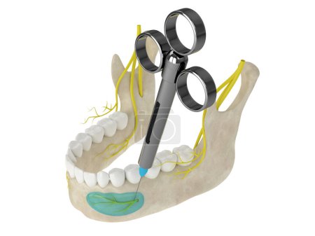 Foto de Arco mandibular con bloqueo del nervio incisivo. Tipos de concepto de anestesia dental. - Imagen libre de derechos