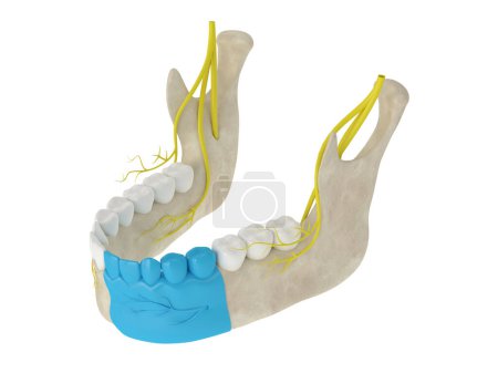 Unterkieferbogen mit durchschneidender Nervenblockade. Arten der Zahnanästhesie Konzept. 