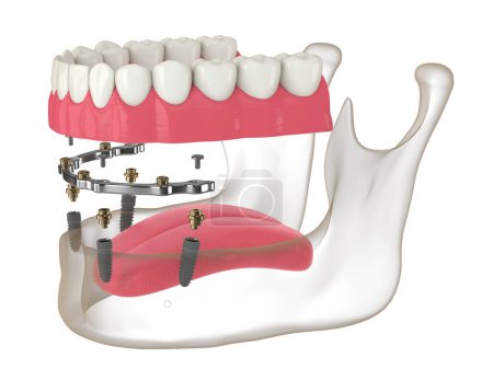 3d render of bar retained removable overdenture installation supported by implants over white
