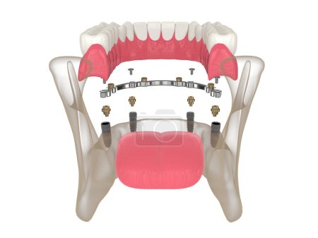 Photo for 3d render of bar retained removable overdenture installation supported by implants over white - Royalty Free Image