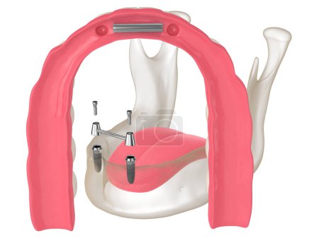 Photo for 3d render of removable overdenture installation on bar clip attachment supported by implants - Royalty Free Image