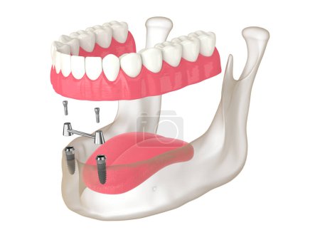 Photo for 3d render of removable overdenture installation on bar clip attachment supported by implants - Royalty Free Image