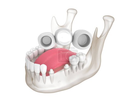 Foto de 3d render of mandible with dental bridge over molar and premolar teeth - Imagen libre de derechos