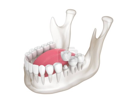 Téléchargez les photos : 3d render of mandible with dental crown embed on reshaped tooth over white background - en image libre de droit