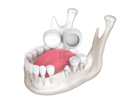 Téléchargez les photos : 3d render of  mandible with dental cantilever bridge over white background - en image libre de droit