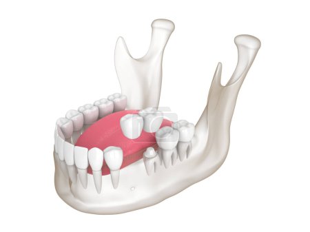 Téléchargez les photos : 3d render of  mandible with dental cantilever bridge over white background - en image libre de droit