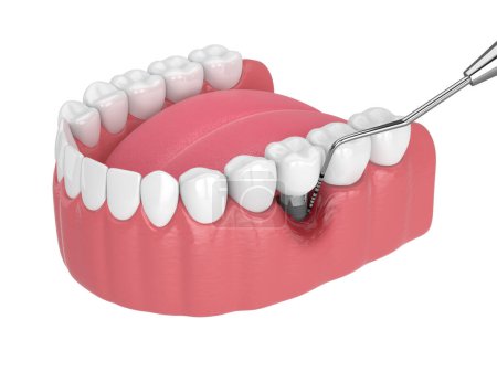 Foto de 3d renderizado de mandíbula humana con enfermedad de peri implantitis y sonda periodontal sobre fondo blanco - Imagen libre de derechos