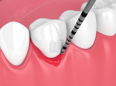 Foto de 3d renderizado de mandíbula humana con enfermedad peri implantitis y sonda periodontal - Imagen libre de derechos