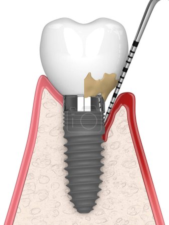 3D-Darstellung von gesundem Implantat versus Implantat mit peripherer Implantitis vor weißem Hintergrund